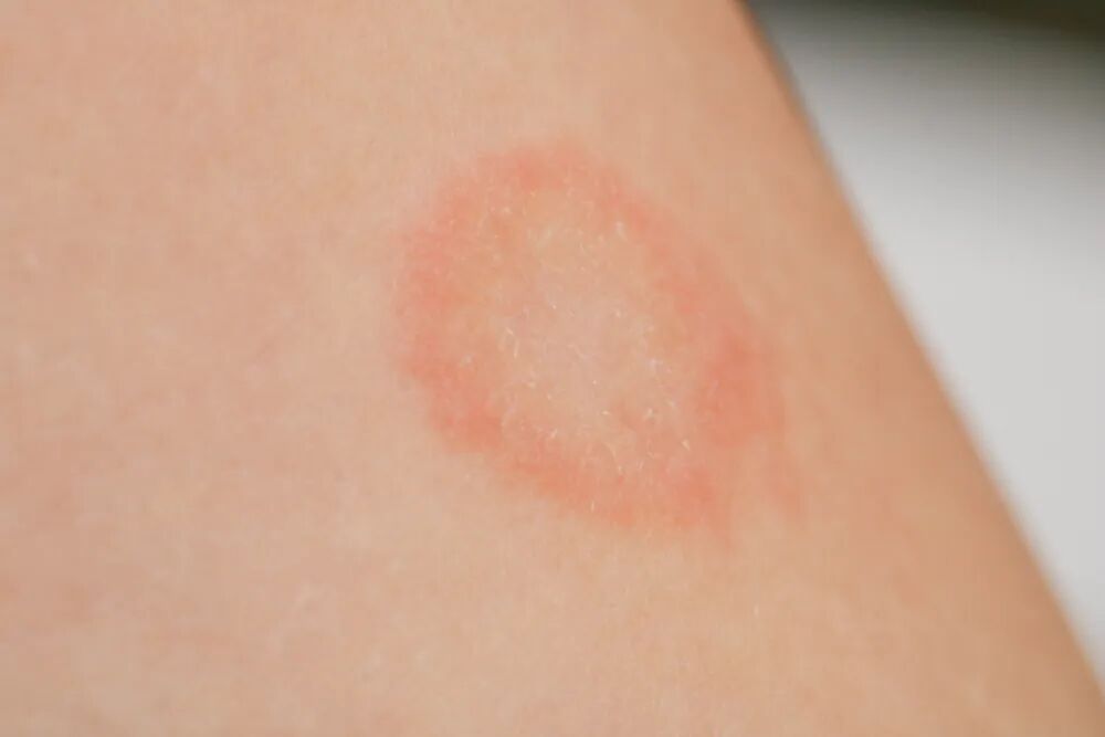  体癣防治：被低估的真菌感染与规范化应对指南 健康养生