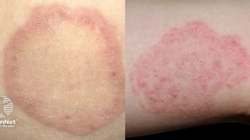  体癣防治：被低估的真菌感染与规范化应对指南 健康养生