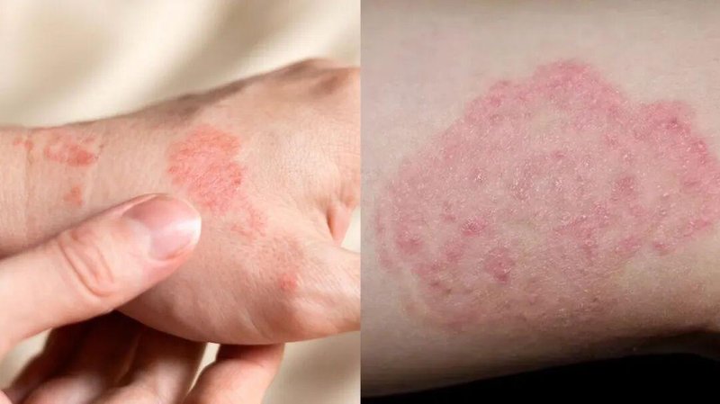  体癣防治：被低估的真菌感染与规范化应对指南 健康养生