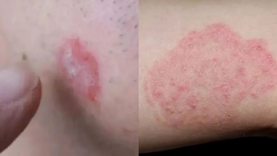  体癣防治：被低估的真菌感染与规范化应对指南 健康养生